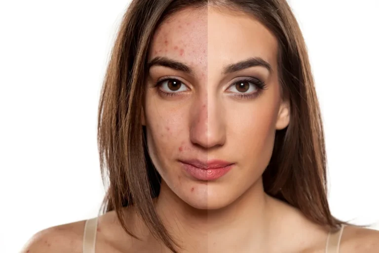 Why Acne,Age Spots & Wrinkles Are Scared Of Apple Cider Vinegar